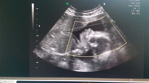 30 haftalık bebek ultrason görüntüsü